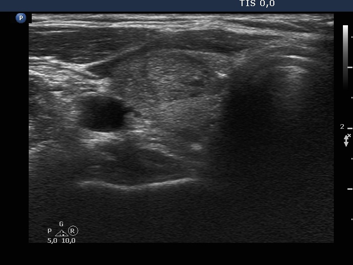 Right lobe, longitudinal scan