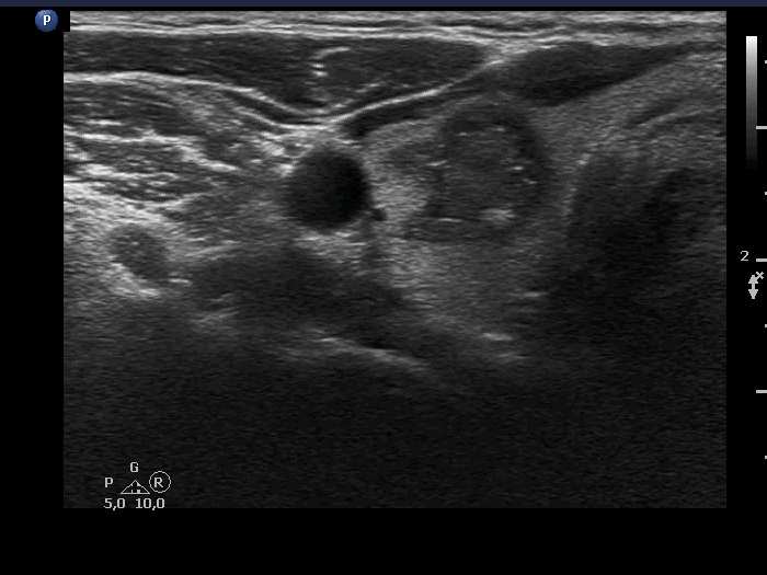 Right lobe, longitudinal scan