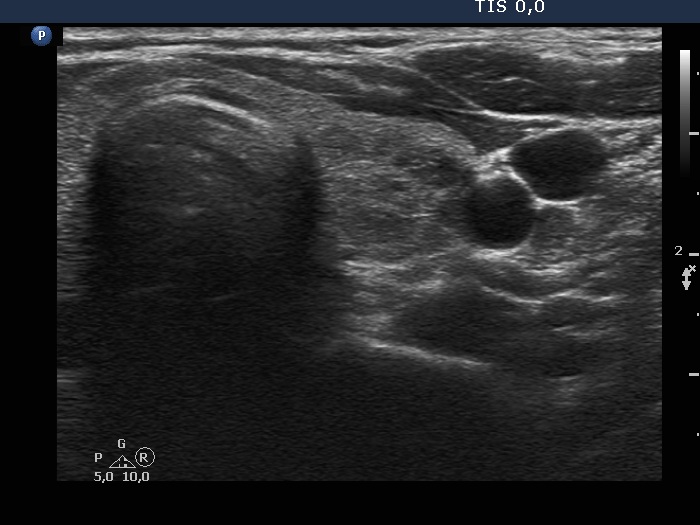 Right lobe, longitudinal scan