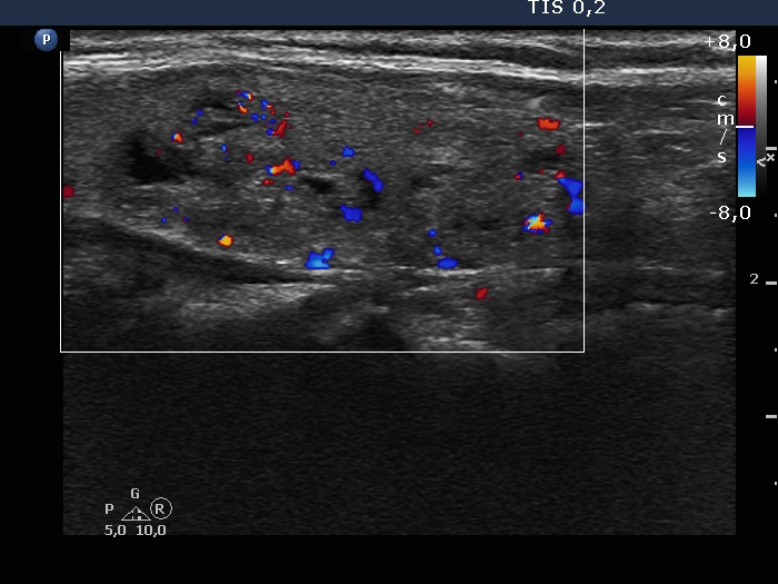 Right lobe, longitudinal scan