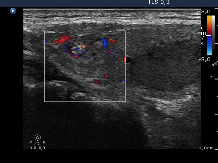 Right lobe, longitudinal scan