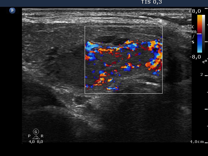 Right lobe, longitudinal scan