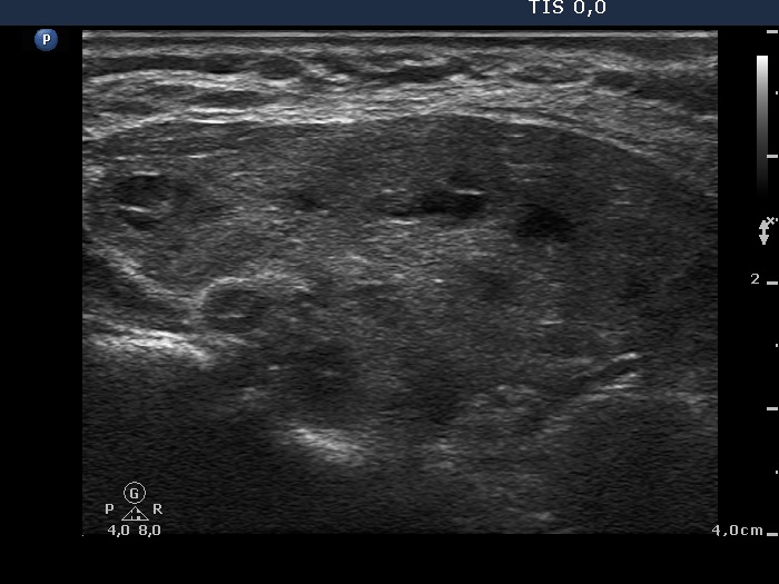Right lobe, longitudinal scan