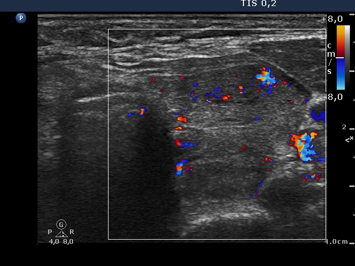 Right lobe, longitudinal scan