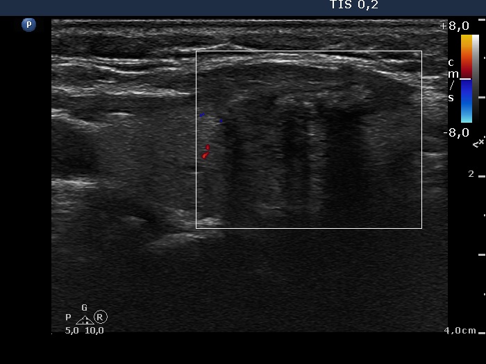 Right lobe, longitudinal scan