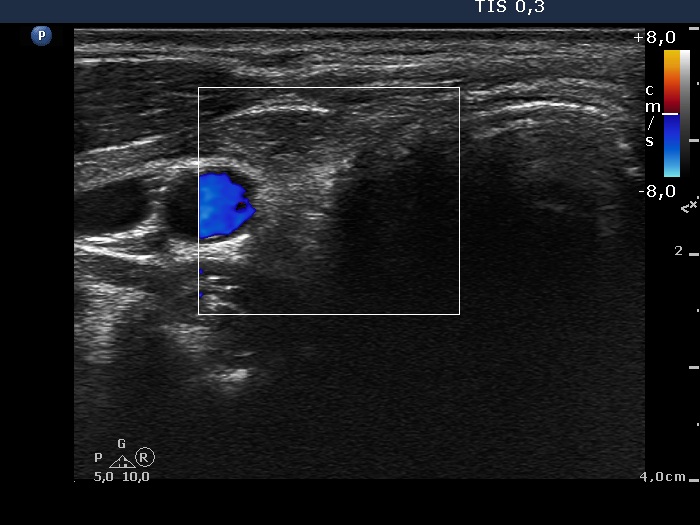 Right lobe, longitudinal scan