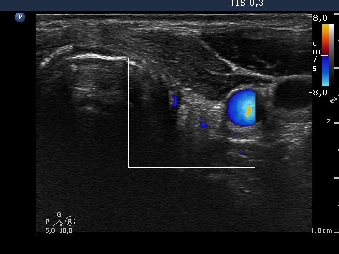 Right lobe, longitudinal scan