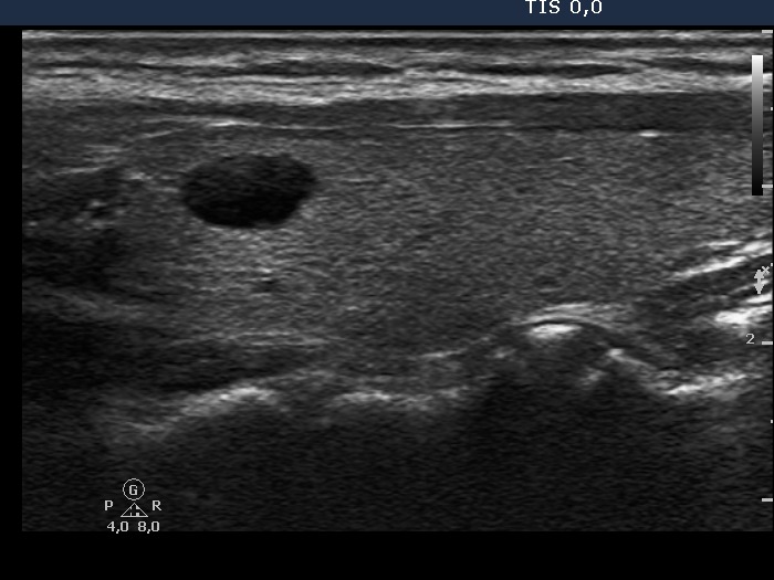 Right lobe, longitudinal scan