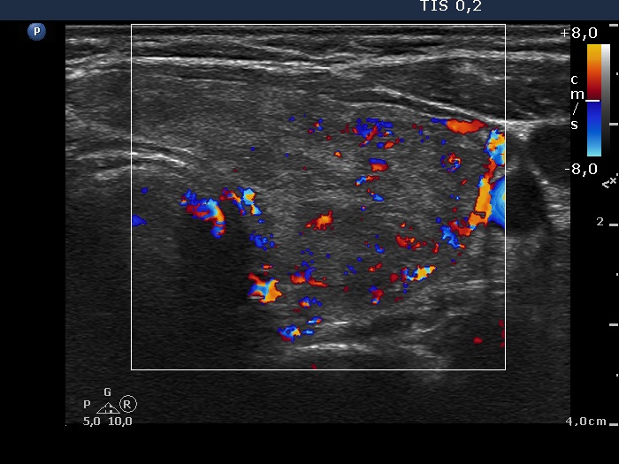 Right lobe, longitudinal scan