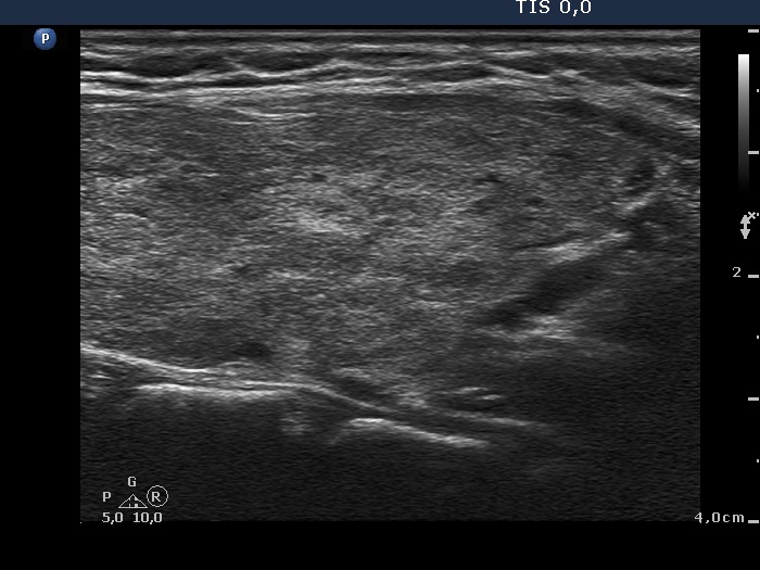 Right lobe, longitudinal scan