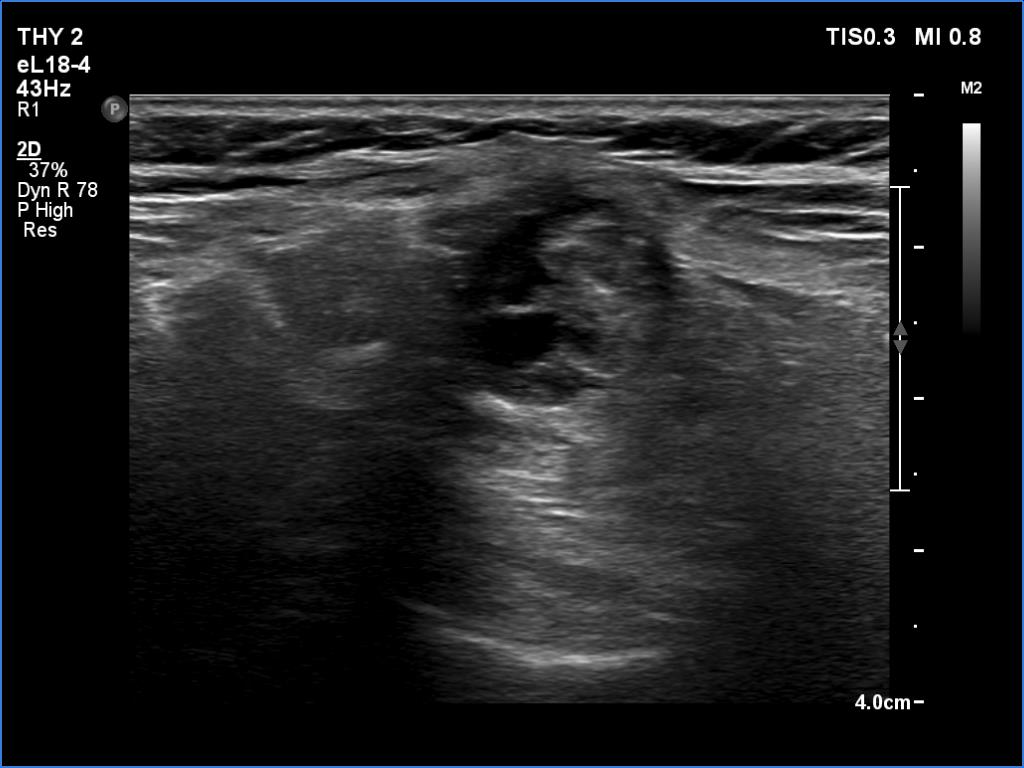Right lobe, longitudinal scan