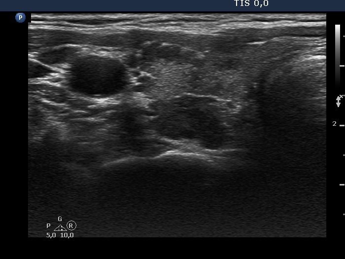 Right lobe, longitudinal scan