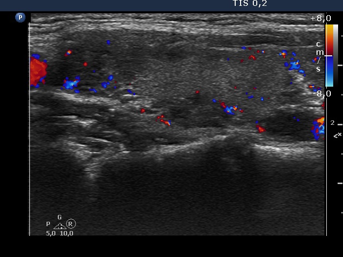 Right lobe, longitudinal scan