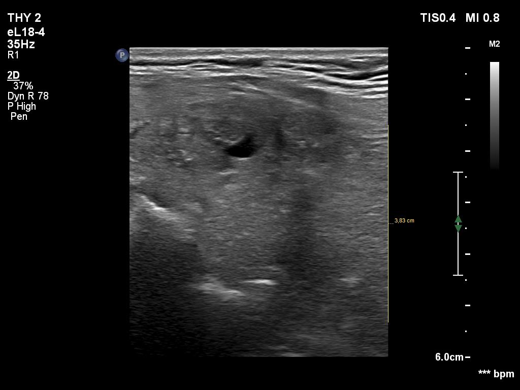Right lobe, longitudinal scan