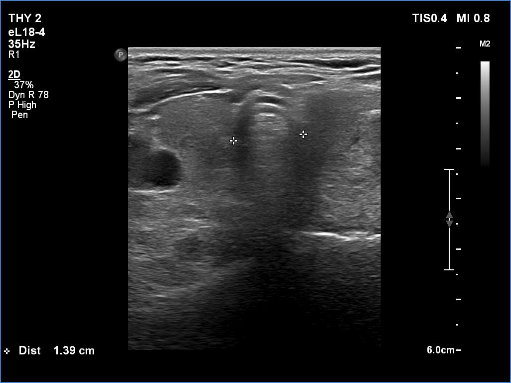 Right lobe, longitudinal scan