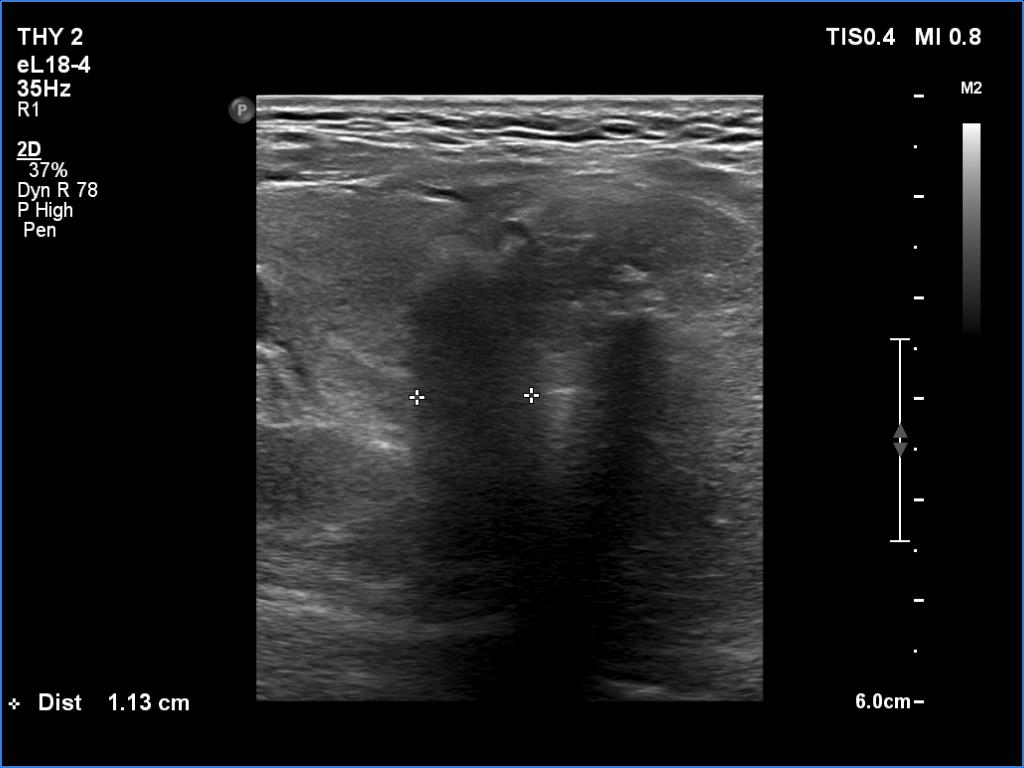 Right lobe, longitudinal scan
