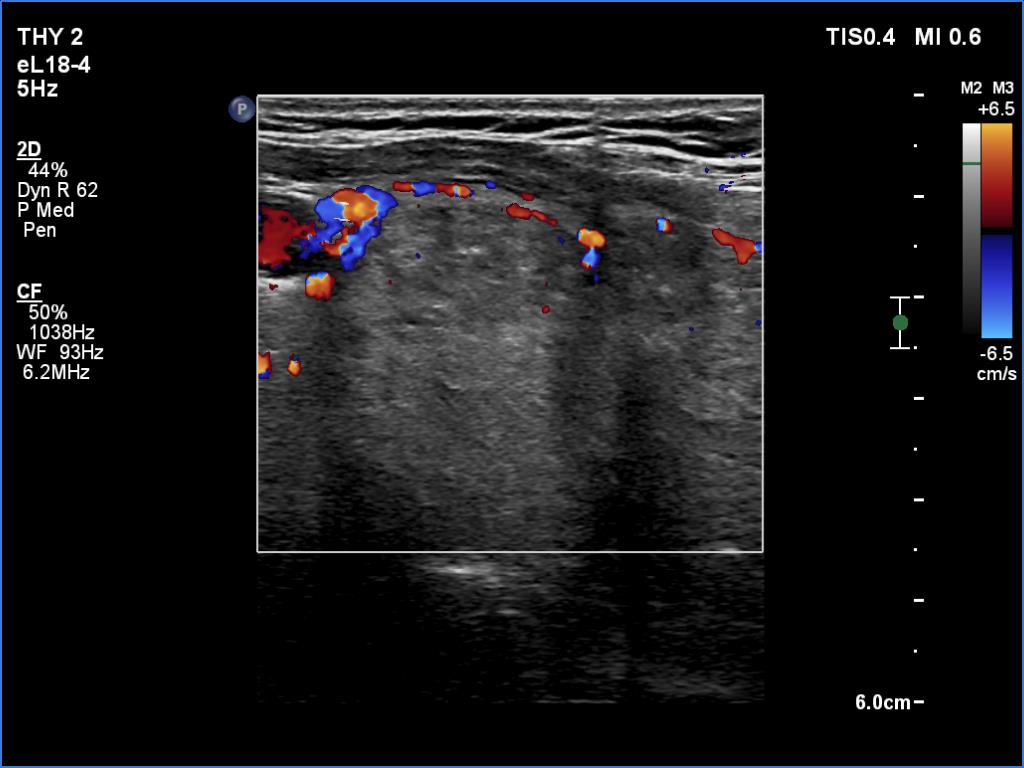 Right lobe, longitudinal scan