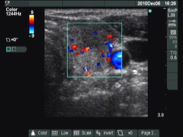 Right lobe, longitudinal scan