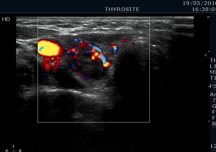 Right lobe, longitudinal scan