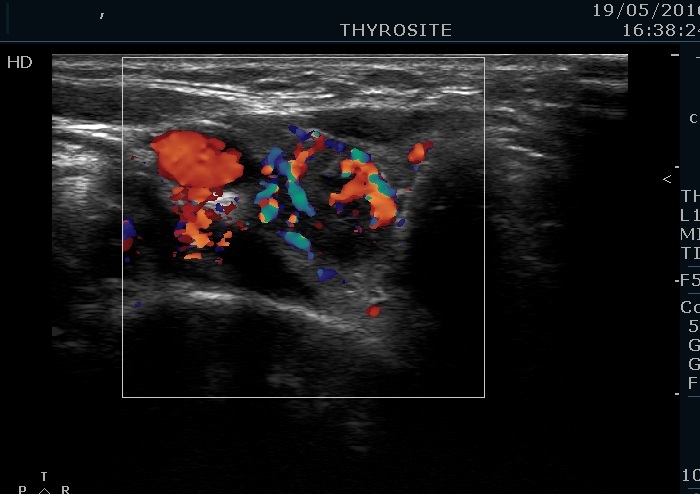 Right lobe, longitudinal scan