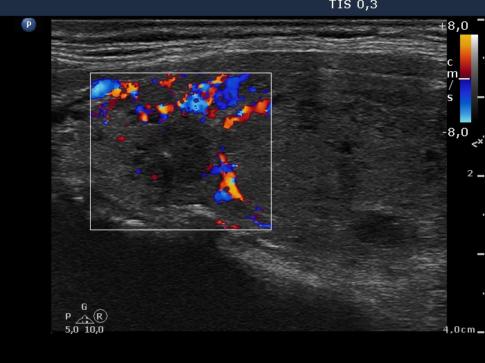 Right lobe, longitudinal scan