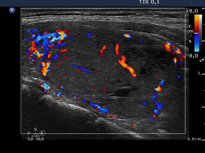 Right lobe, longitudinal scan