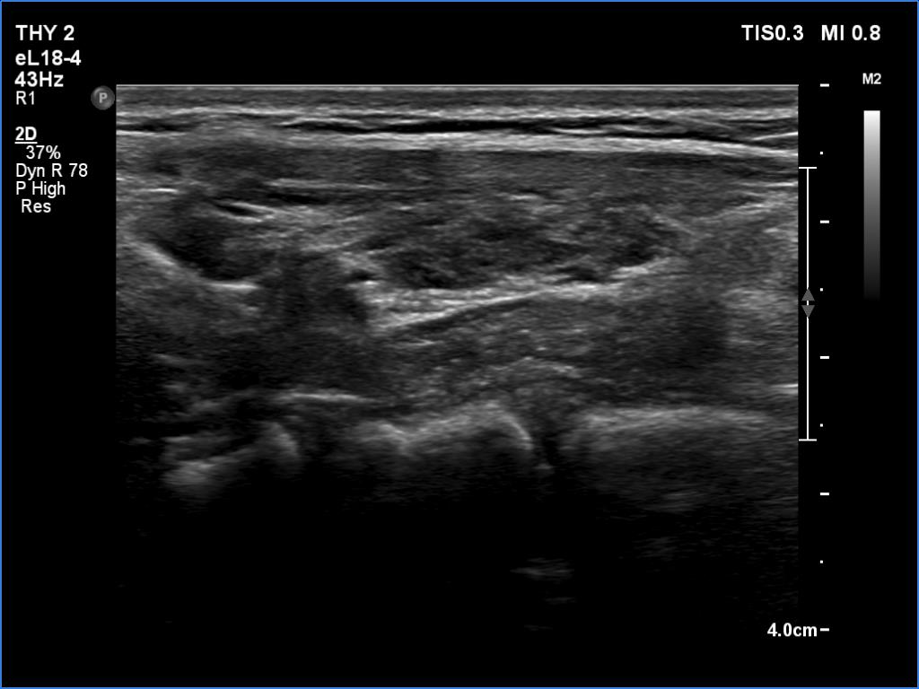 Right lobe, longitudinal scan
