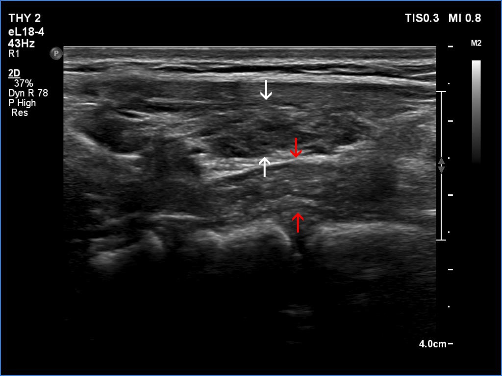 Right lobe, longitudinal scan
