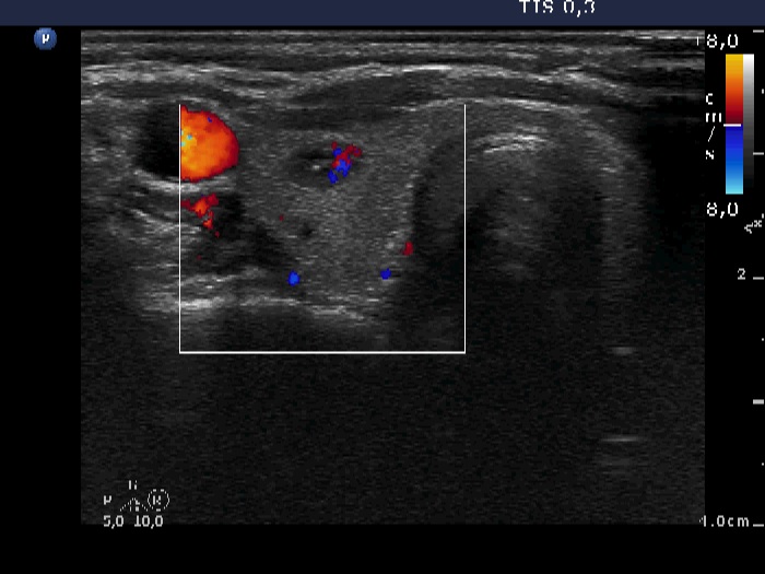 Right lobe, longitudinal scan