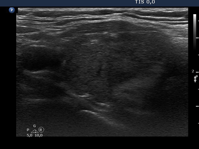 Right lobe, longitudinal scan