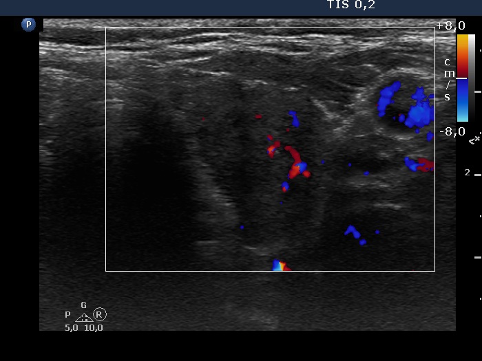 Right lobe, longitudinal scan