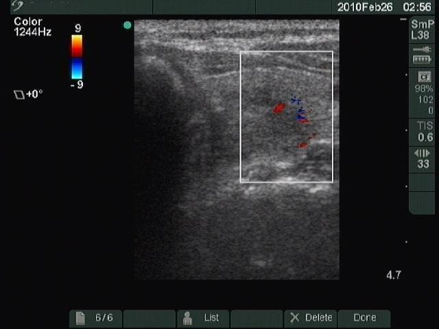 Right lobe, longitudinal scan