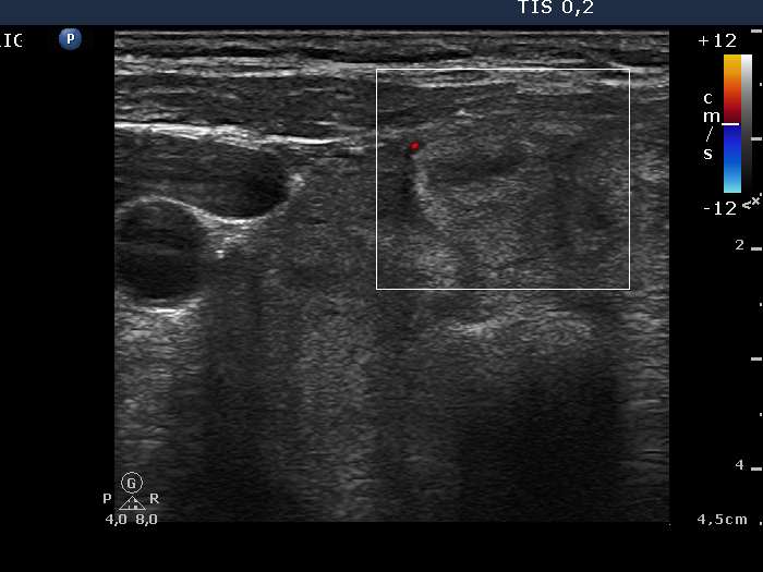 Right lobe, longitudinal scan