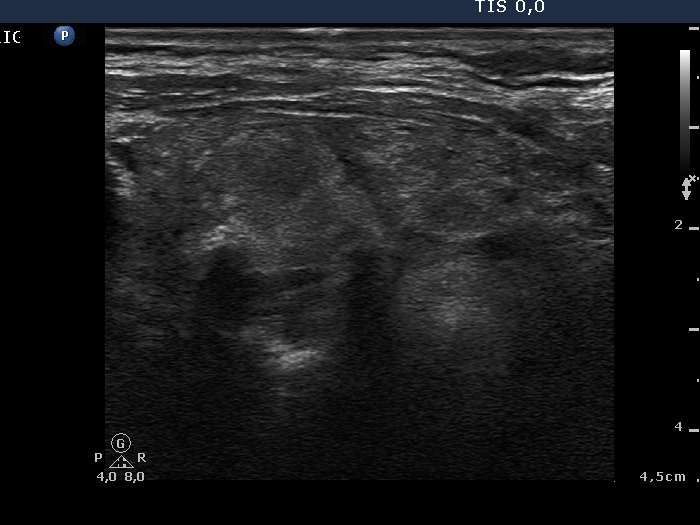 Right lobe, longitudinal scan