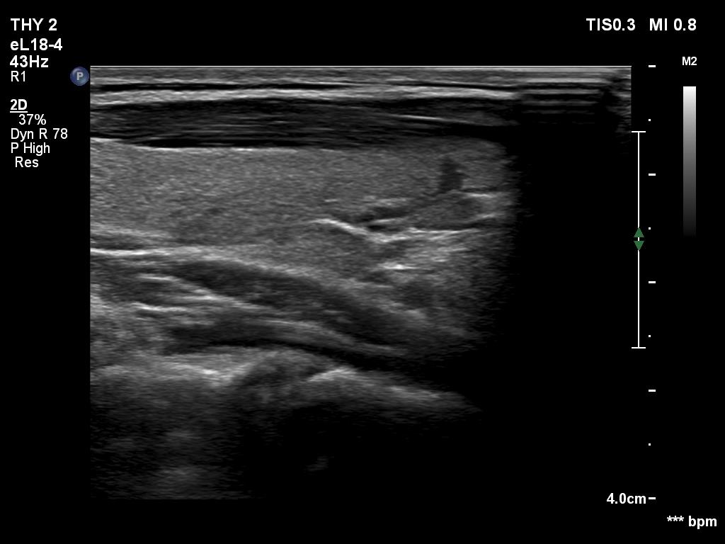 Right lobe, longitudinal scan