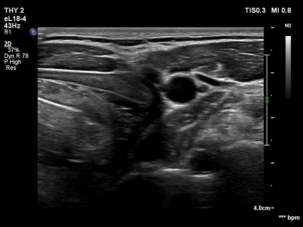 Right lobe, longitudinal scan