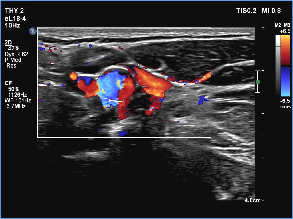 Right lobe, longitudinal scan