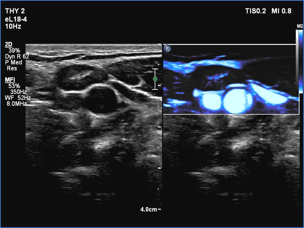 Right lobe, longitudinal scan