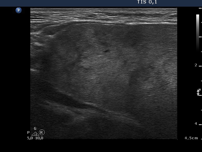 Right lobe, longitudinal scan