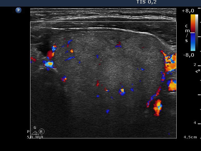 Right lobe, longitudinal scan