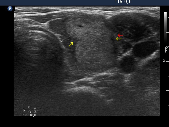 Right lobe, longitudinal scan