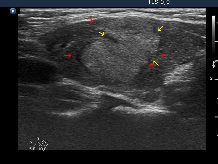 Right lobe, longitudinal scan