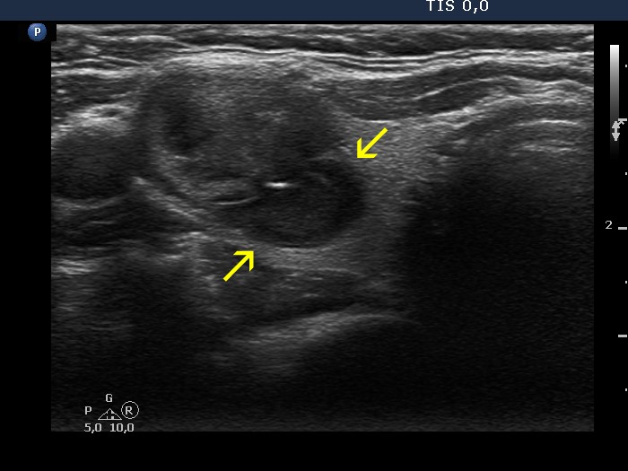 Right lobe, longitudinal scan