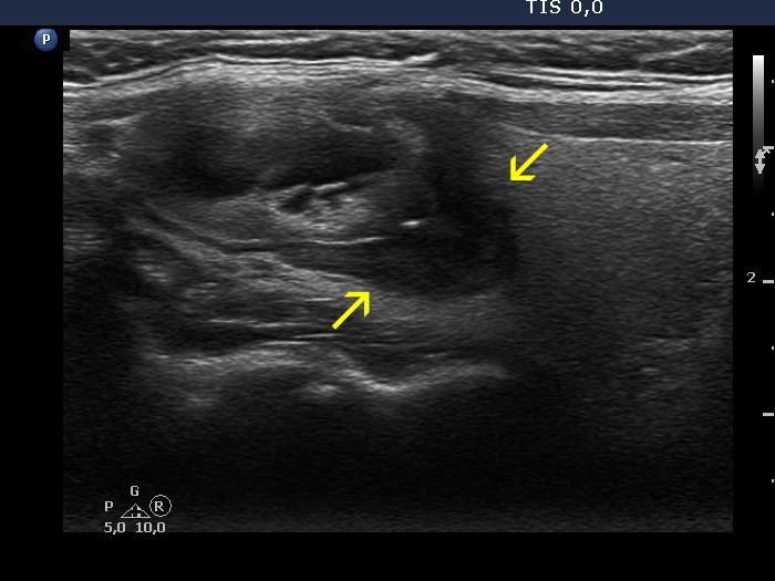 Right lobe, longitudinal scan