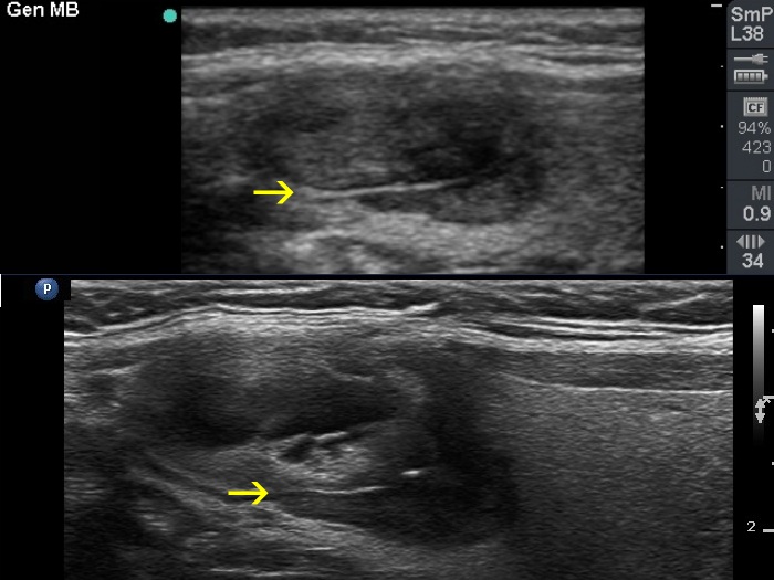 Right lobe, longitudinal scan