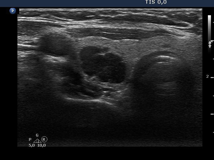 Right lobe, longitudinal scan