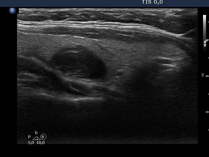 Right lobe, longitudinal scan