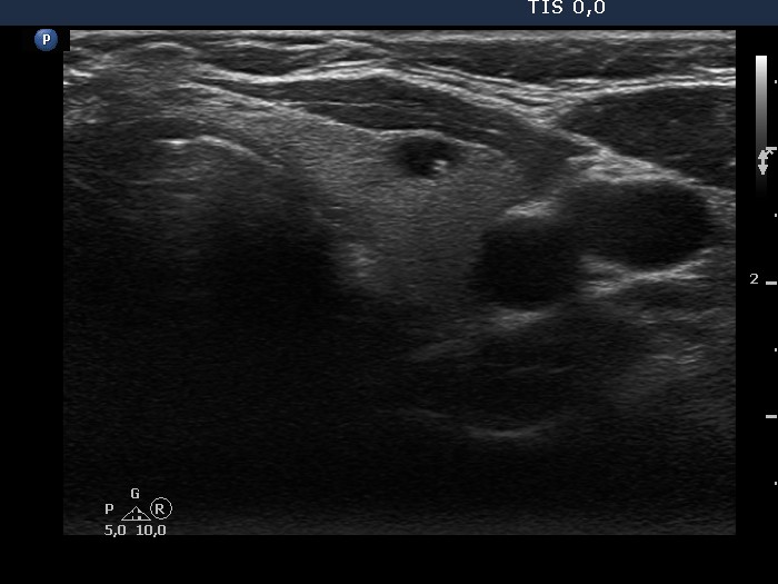 Right lobe, longitudinal scan