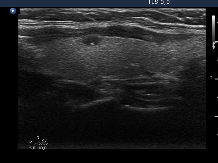 Right lobe, longitudinal scan