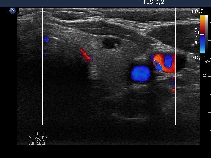 Right lobe, longitudinal scan